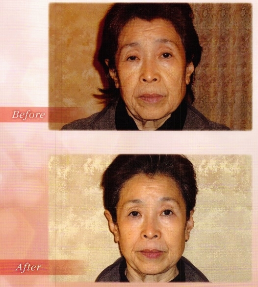 エレクトロポレーションの効果実例