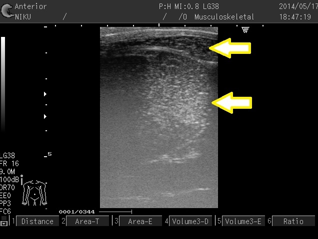 超音波画像診断装置の解析イメージ
