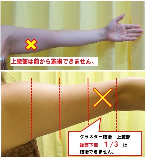 HIFU