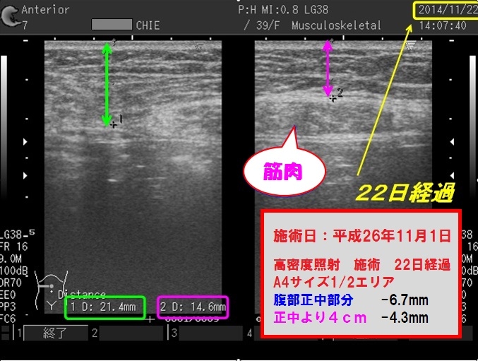 HIFU